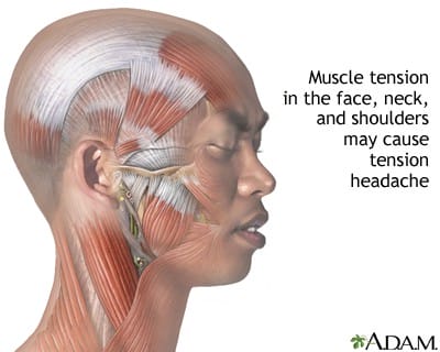 muscles in head causing tension headaches