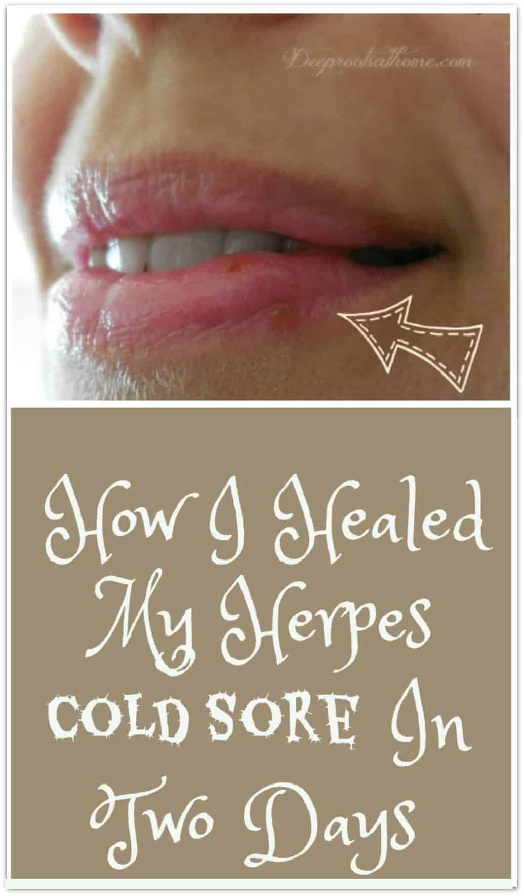 My Protocol To Dry Up & Heal A Herpes Cold Sore In 2 To 3 Days