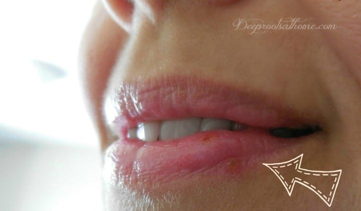 My Protocol To Dry Up & Heal A Herpes Cold Sore In 2 To 3 Days. A close-up of my lips at day 3 of an almost healed cold sore. 