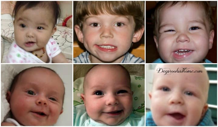 strabismus