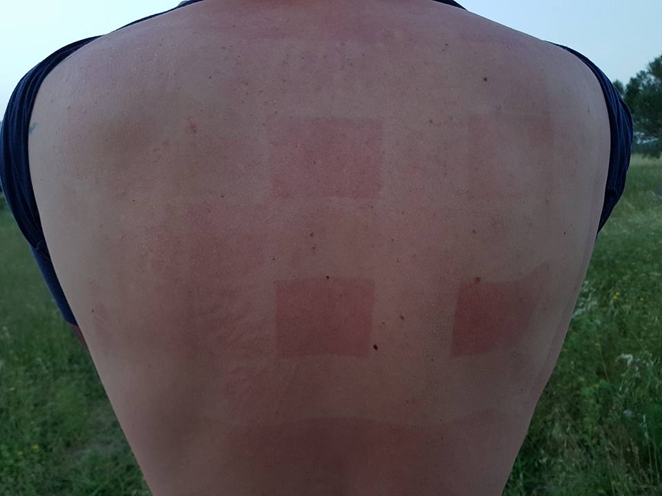  Results of sunscreen test on man's back.