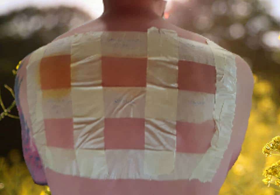 Plant-Based Sun Protection: Skin Tests Done In Spain. Masking tape on man's back making a grid to test sunscreen