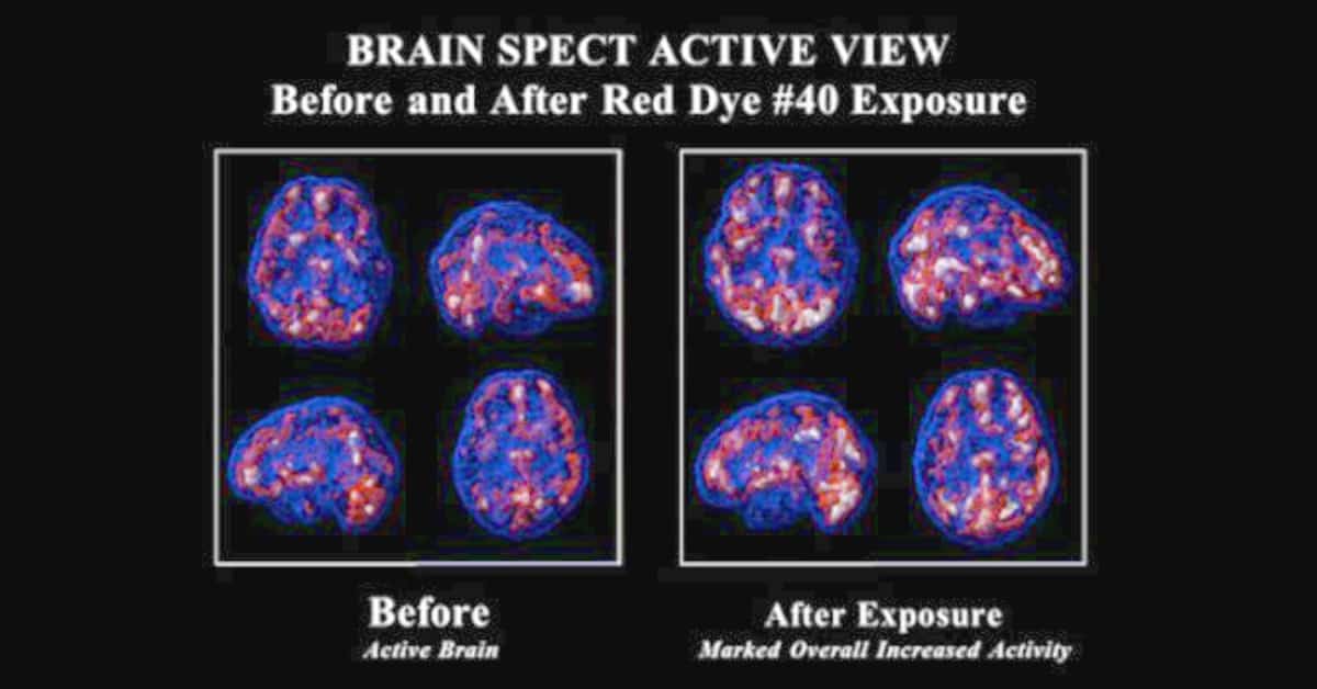 Red Dye #40 Can Make Non-ADD Kids Hyperactive & Alter Brain Function Red Dye #40 Can Make Non-ADD Kids Hyperactive & Alter Brain Function. SPECT brain images before and after red dye consumption.