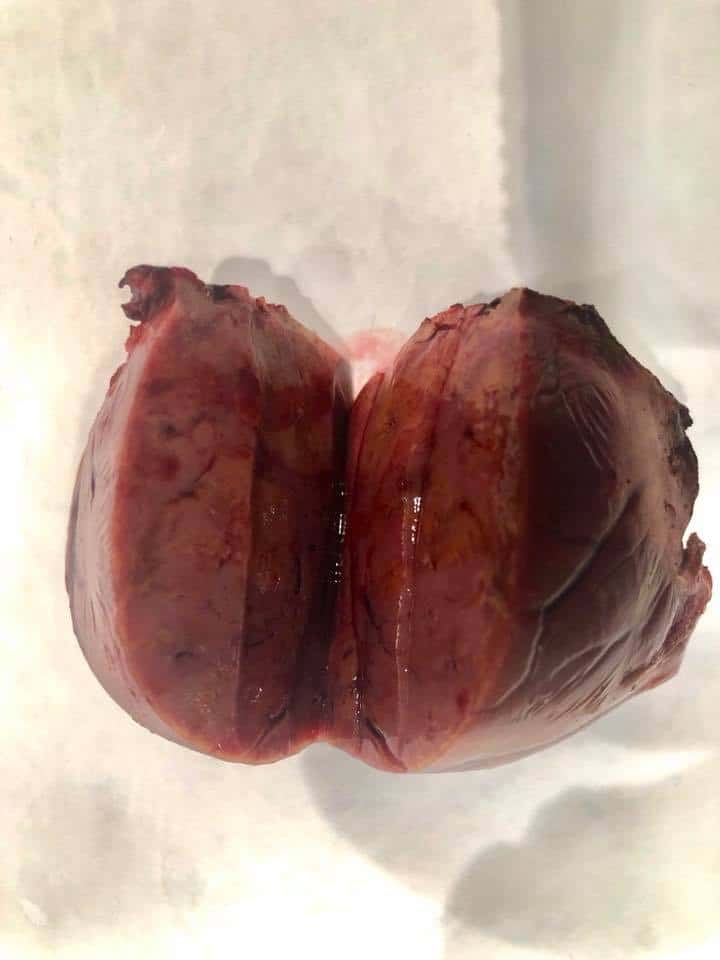 Birth Control Pills: What One Young Woman Wishes She'd Known. A surgically removed portion of a girl's liver. 