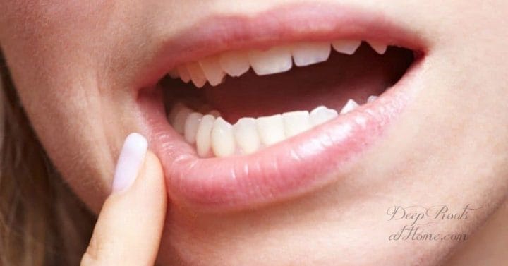 Real Life Oil Pulling: Avoid Crowns, Stop Infection & Reverse Cavities. a woman's open mouth and teeth