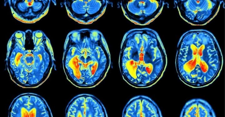Gadolinium MRI Dye: A Nano Heavy Metal That Insults Your Body. an MRI image