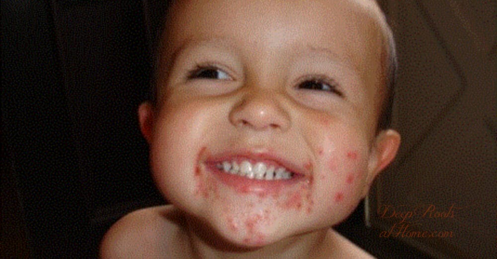 What To Have On Hand for Hand, Foot and Mouth Disease