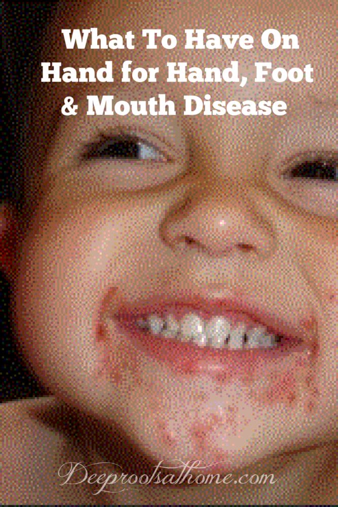 What To Have On Hand for Hand, Foot and Mouth Disease