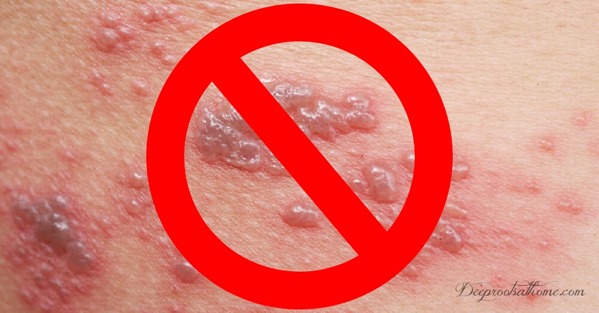 Shingles: Two Natural Preventative OTCs To The Rescue