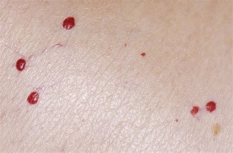 Elevated Bromine Levels Implicated In Every Thyroid Disease Elevated Bromine Levels Implicated In Every Thyroid Disease
