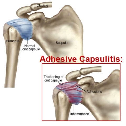 Thiosinaminum for Frozen Shoulder, Adhesions, Scarring, Fibroids Thiosinaminum for Frozen Shoulder, Adhesions, Scarring, Fibroids