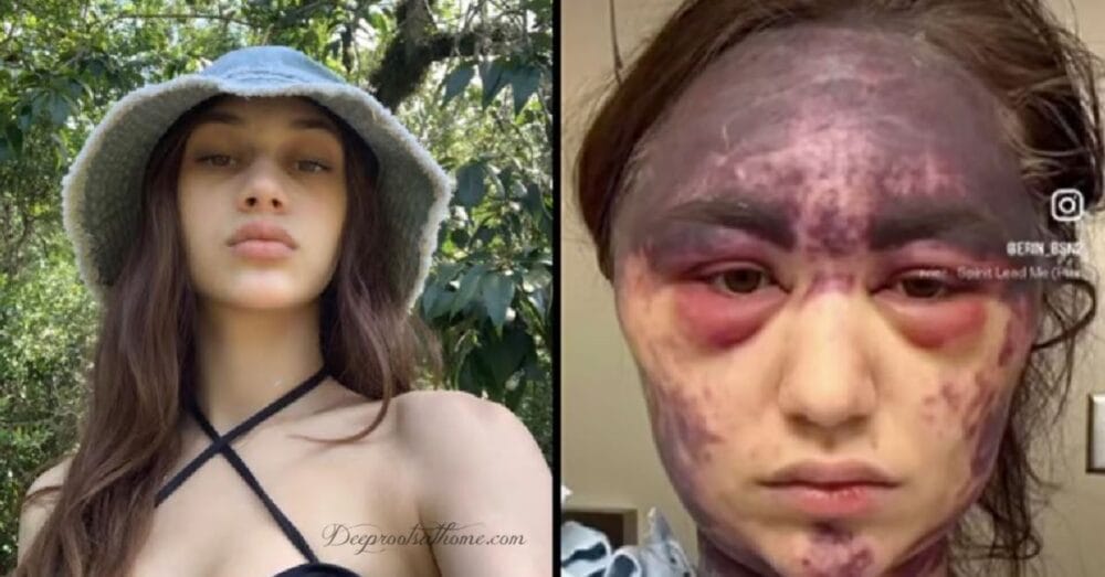 Reacting w/ Thrombocytopenic Purpura Minutes After Vacs Reacting w/ Thrombocytopenic Purpura Minutes After Vacs