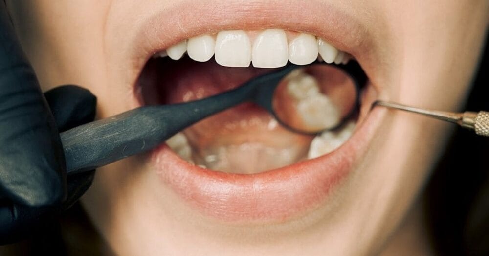 9 Natural Substances Can Effectively Remineralize Dental Enamel