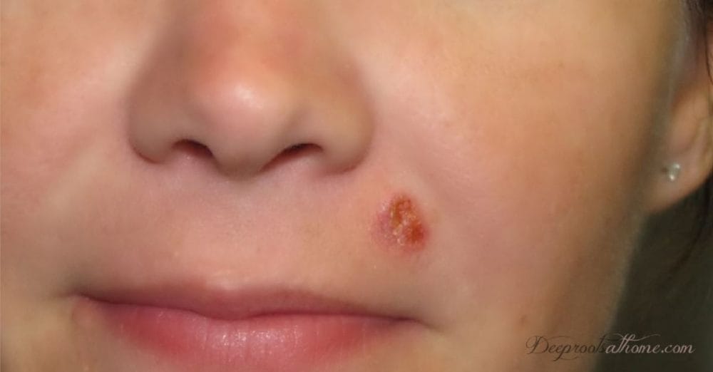 Squamous Cell Cancer Cleared by Topical Fenbendazole: Photos Squamous Cell Cancer Cleared by Topical Fenbendazole: Photos