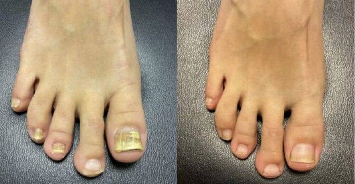 Eradicate Toenail Fungus For Good w/ Povidone-Iodine & DMSO