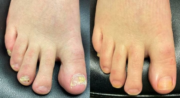 Eradicate Toenail Fungus For Good w/ Iodine & DMSO